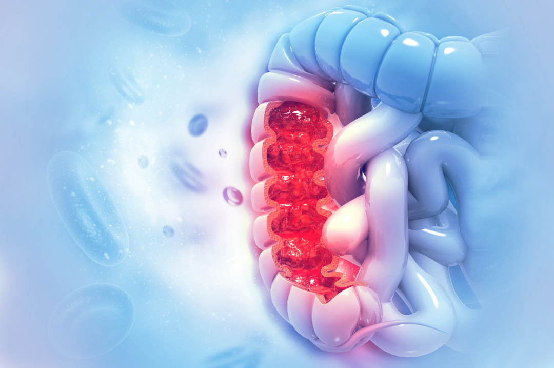 The American Cancer Society estimates that in 2021, the number of new cases of colorectal cancer will be 150,000.
